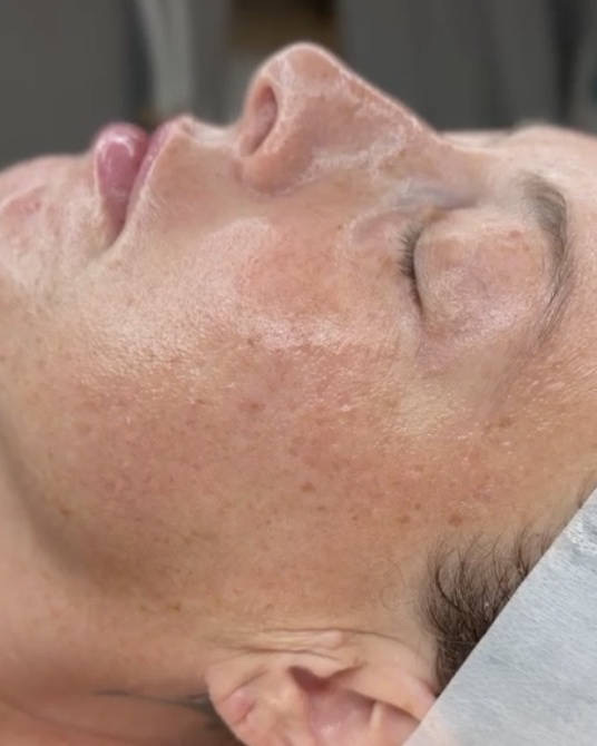 Profil einer Kundin mit glänzender Haut nach der Behandlung